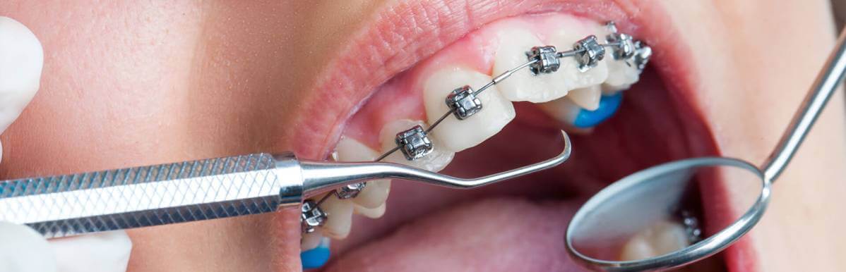 Ortodontik Tedavi Nedir? 